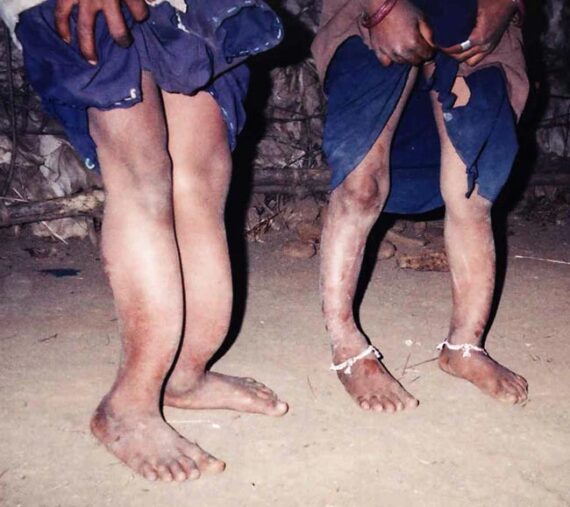 SSSIHL-Research-Spotlight-Skeletal-Fluorosis